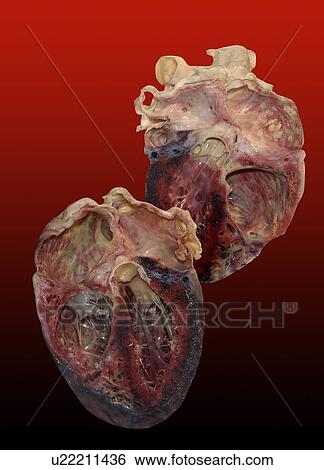 Stock Photograph - Dissected human heart.. Fotosearch