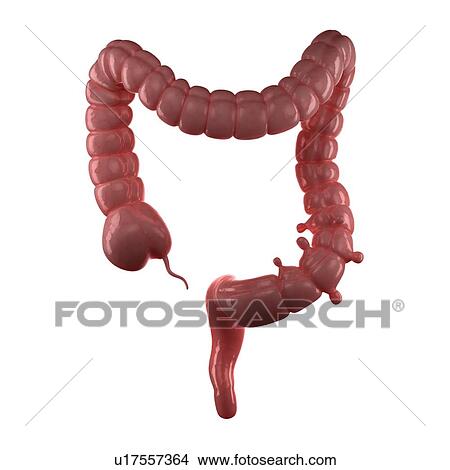Diverticulosis. Computer artwork of small pouches (diverticuli) in the large intestine. View Large Photo Image Picture - Diverticulosis. Computer artwork of small pouches (diverticuli) in the large intestine.. Fotosearch