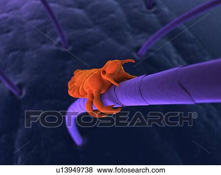Head louse (Pediculus humanus capitis), computer artwork. View Large Photo Image Stock Photo - Head louse (Pediculus humanus capitis), computer artwork.. Fotosearch