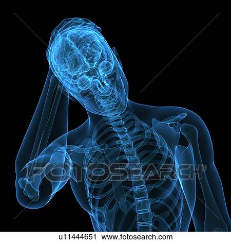 Stock Image - Headache, conceptual computer artwork.. Fotosearch