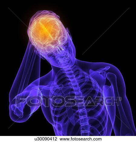 Stock Image - Headache, conceptual computer artwork.. Fotosearch