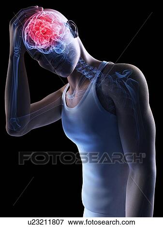 Stock Photo - Headache, conceptual computer artwork.. Fotosearch