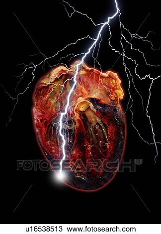 Stock Image - Heart attack, conceptual computer artwork.. Fotosearch