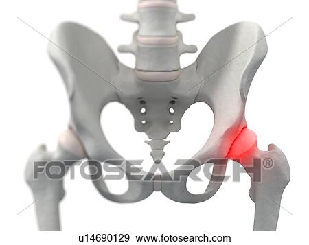 Stock Photo - Hip pain, conceptual computer artwork.. Fotosearch