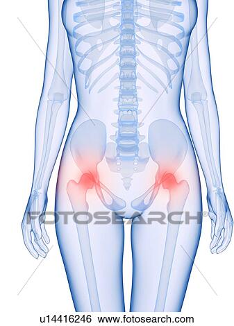 Stock Photograph - Hip pain, conceptual computer artwork.. Fotosearch