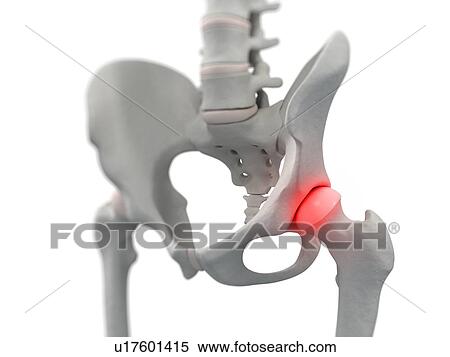 Hip pain, conceptual computer artwork. View Large Photo Image Stock Photography - Hip pain, conceptual computer artwork.. Fotosearch