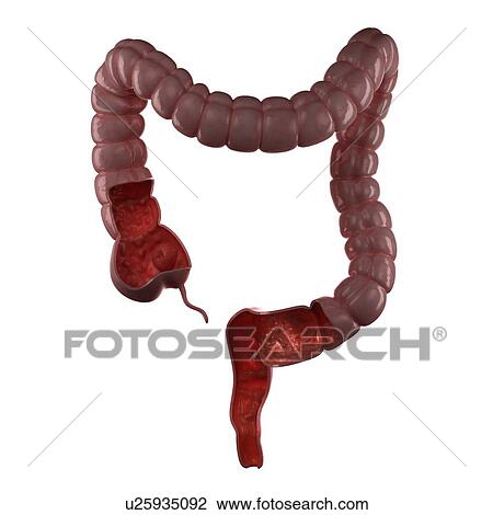 Stock Image - Inflamed large intestine, computer artwork.. Fotosearch