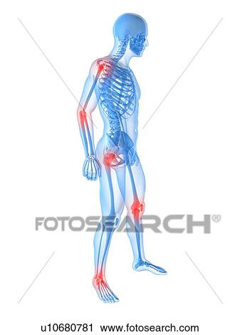 Stock Image - Joint pain, conceptual computer artwork.. Fotosearch