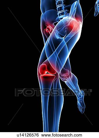 Stock Photograph - Joint pain, conceptual computer artwork.. Fotosearch