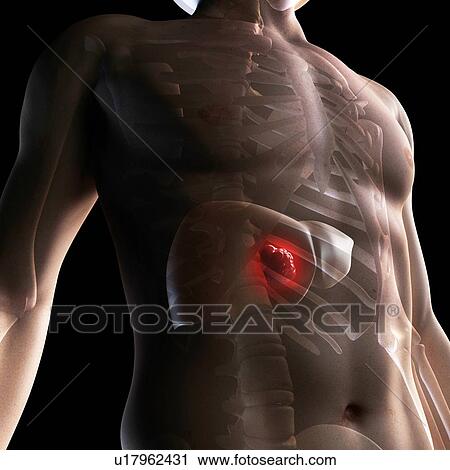 Liver cancer, computer artwork. View Large Photo Image Stock Image - Liver cancer, computer artwork.. Fotosearch