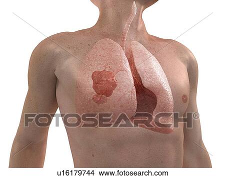 Lung cancer, computer artwork. View Large Photo Image Picture - Lung cancer, computer artwork.. Fotosearch