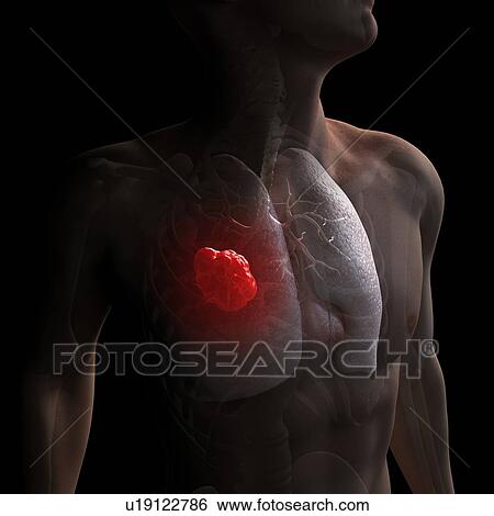 Lung cancer, computer artwork. View Large Photo Image Stock Photograph - Lung cancer, computer artwork.. Fotosearch