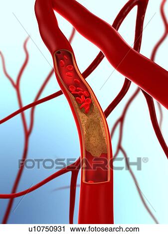 Stock Image - Narrowed artery. Computer artwork of an artery that is partially blocked by an atheroma.. Fotosearch