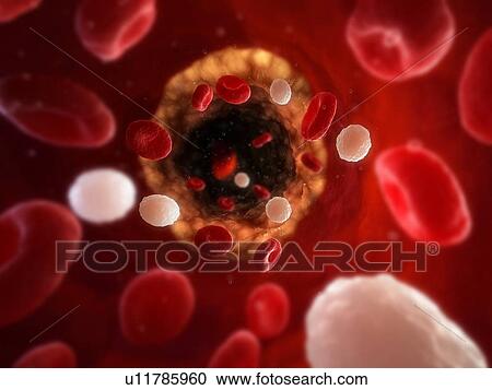 Stock Image - Narrowed artery. Computer artwork of an artery that is partially blocked by an atheroma (yellow).. Fotosearch