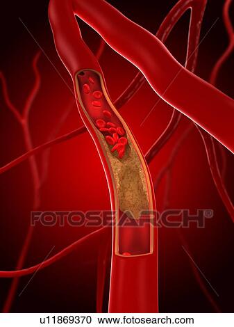 Narrowed artery. Computer artwork of an artery that is partially blocked by an atheroma. View Large Photo Image Stock Image - Narrowed artery. Computer artwork of an artery that is partially blocked by an atheroma.. Fotosearch