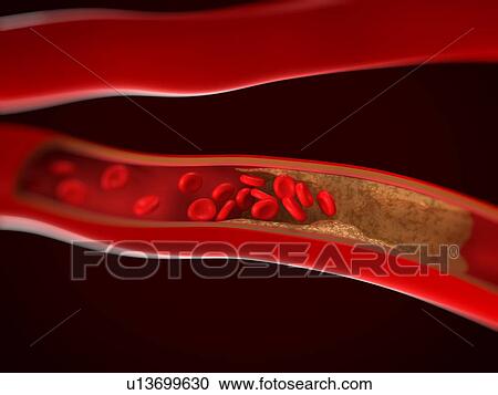 Narrowed artery. Computer artwork of an artery that is partially blocked by an atheroma. View Large Photo Image Stock Image - Narrowed artery. Computer artwork of an artery that is partially blocked by an atheroma.. Fotosearch