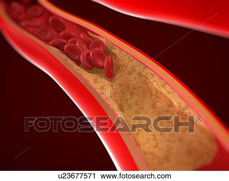 Stock Image - Narrowed artery. Computer artwork of an artery that is partially blocked by an atheroma.. Fotosearch