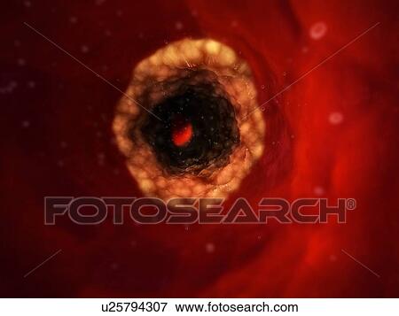 Stock Photo - Narrowed artery. Computer artwork of an artery that is partially blocked by an atheroma (yellow).. Fotosearch