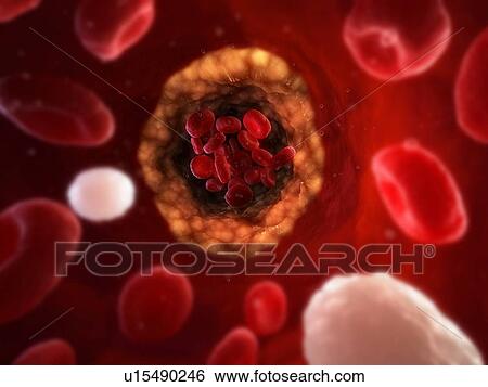 Stock Photograph - Narrowed artery. Computer artwork of an artery that is partially blocked by an atheroma (yellow).. Fotosearch