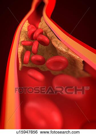 Stock Photograph - Narrowed artery. Computer artwork of an artery that is partially blocked by an atheroma.. Fotosearch