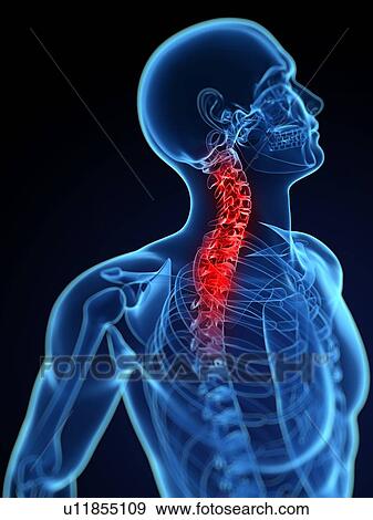 Stock Photo - Neck pain, conceptual computer artwork.. Fotosearch