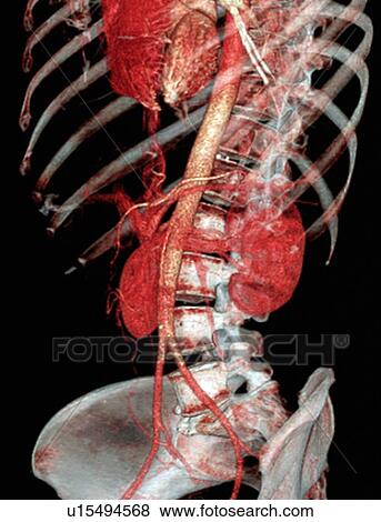 Normal abdomen. Coloured 3D computed tomography (CT) scan of the healthy abdomen and chest of a 53 year old patient. At top centre is the heart. The aorta, the largest artery in the body, runs down centre before dividing into the iliac arteries. The kidne View Large Photo Image Stock Photo - Normal abdomen. Coloured 3D computed tomography (CT) scan of the healthy abdomen and chest of a 53 year old patient. At top centre is the heart. The aorta, the largest artery in the body, runs down centre before dividing into the iliac arteries. The kidne. Fotosearch