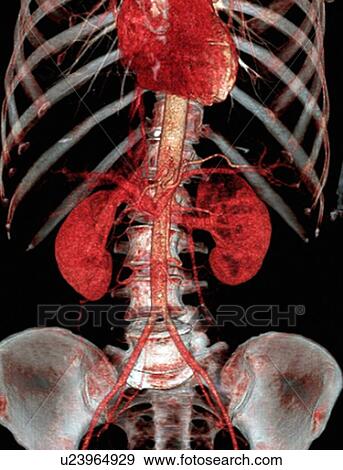 Stock Photo - Normal abdomen. Coloured 3D computed tomography (CT) scan of the healthy abdomen and chest of a 53 year old patient. At top centre is the heart. The aorta, the largest artery in the body, runs down centre before dividing into the iliac arteries. The kidne. Fotosearch