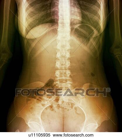 Stock Photography - Normal abdomen. Coloured X-ray of the abdomen of a 20 year old female.. Fotosearch