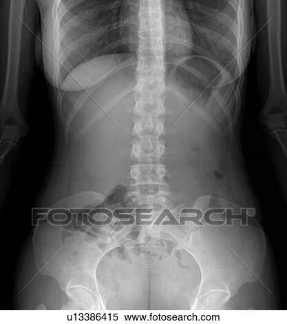 Normal abdomen. X-ray of the abdomen of a 20 year old female. View Large Photo Image Stock Photography - Normal abdomen. X-ray of the abdomen of a 20 year old female.. Fotosearch