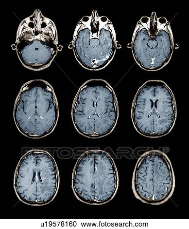 Stock Image - Normal brain. Coloured magnetic resonance imaging (MRI) scans of axial sections through the healthy brain of a 28 year old patient. Structures have been highlighted by the injection of gadolinium contrast medium.. Fotosearch