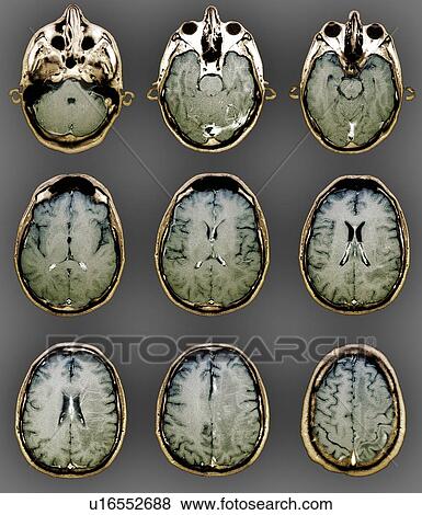 Normal brain. Coloured magnetic resonance imaging (MRI) scans of axial sections through the healthy brain of a 28 year old patient. Structures have been highlighted by the injection of gadolinium contrast medium. View Large Photo Image Stock Photo - Normal brain. Coloured magnetic resonance imaging (MRI) scans of axial sections through the healthy brain of a 28 year old patient. Structures have been highlighted by the injection of gadolinium contrast medium.. Fotosearch