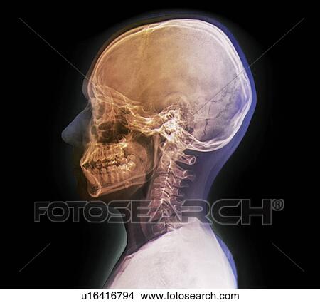 Normal child's head. Coloured X-ray of the head of a 13 year old. View Large Photo Image Picture - Normal child's head. Coloured X-ray of the head of a 13 year old.. Fotosearch