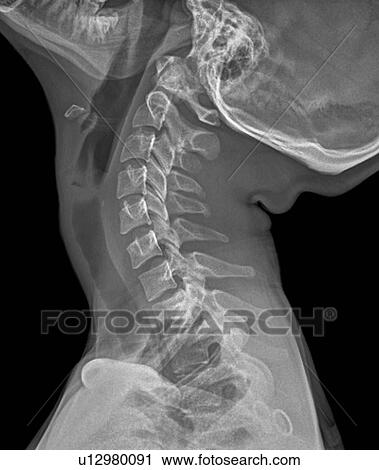 Normal extended neck. X-ray of the extended cervical spine of a 20 year