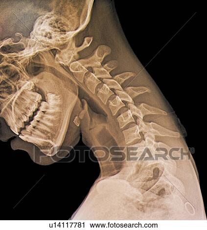 Stock Image - Normal flexed neck. Coloured X-ray of the flexed cervical spine of a 20 year old female.. Fotosearch
