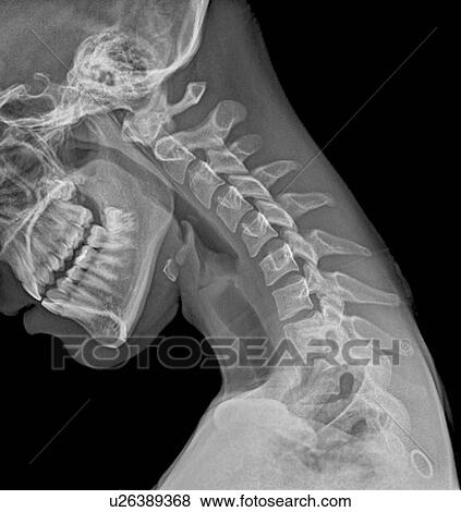 Pictures of Normal flexed neck. X-ray of the flexed cervical spine of a