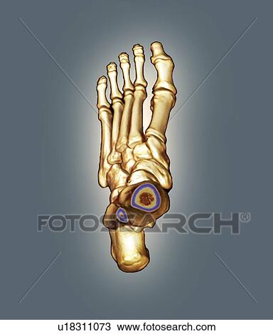 Stock Image - Normal foot. Coloured 3D computed tomography (CT) scan of the healthy foot of a 23 year old patient.. Fotosearch