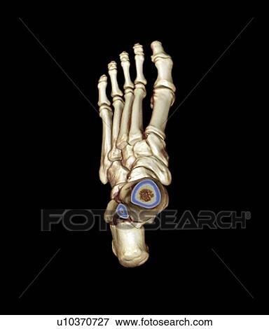 Stock Photo - Normal foot. Coloured 3D computed tomography (CT) scan of the healthy foot of a 23 year old patient.. Fotosearch
