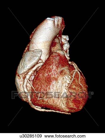 Normal heart. 3D computed tomography (CT) scan of a healthy heart from a 58 year old male. View Large Photo Image Stock Photo - Normal heart. 3D computed tomography (CT) scan of a healthy heart from a 58 year old male.. Fotosearch