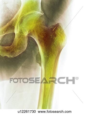 Normal hip. Coloured X-ray of the hip of a 90 year old man. View Large Photo Image Stock Image - Normal hip. Coloured X-ray of the hip of a 90 year old man.. Fotosearch