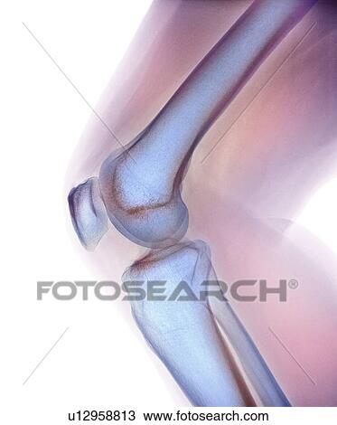 Normal knee. Coloured X-ray of the knee of a 44 year old woman. View Large Photo Image Stock Image - Normal knee. Coloured X-ray of the knee of a 44 year old woman.. Fotosearch