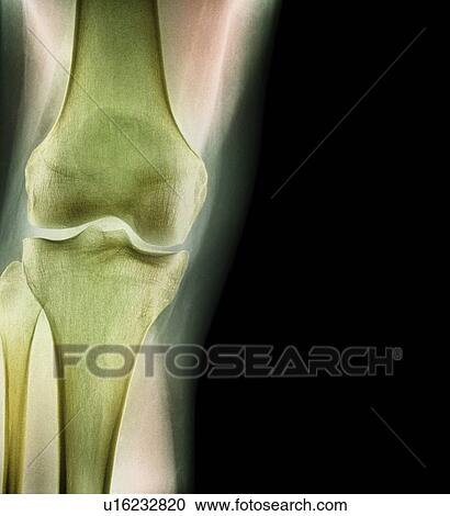Normal knee. Coloured X-ray of the knee of a 44 year old woman. View Large Photo Image Stock Image - Normal knee. Coloured X-ray of the knee of a 44 year old woman.. Fotosearch