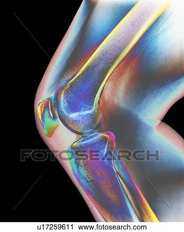 Stock Image - Normal knee. Coloured X-ray of the knee of a 44 year old woman.. Fotosearch