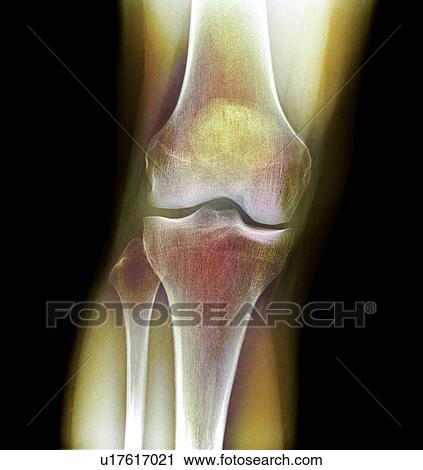 Stock Image - Normal knee. Coloured X-ray of the knee of a 44 year old woman.. Fotosearch
