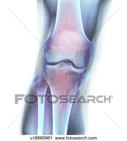 Stock Image - Normal knee. Coloured X-ray of the knee of a 44 year old woman.. Fotosearch