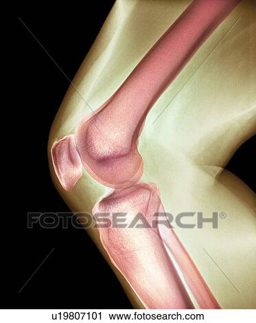 Normal knee. Coloured X-ray of the knee of a 44 year old woman. View Large Photo Image Stock Image - Normal knee. Coloured X-ray of the knee of a 44 year old woman.. Fotosearch