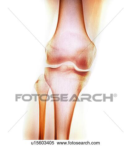 Stock Photography - Normal knee. Coloured X-ray of the knee of a 44 year old woman.. Fotosearch
