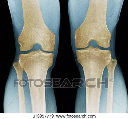 Normal knees. Coloured frontal X-ray of the flexed knees of a 24 year old patient. View Large Photo Image Stock Photo - Normal knees. Coloured frontal X-ray of the flexed knees of a 24 year old patient.. Fotosearch