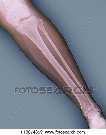 Normal lower leg. Coloured X-ray of the lower leg of a 24 year old woman. View Large Photo Image Stock Photo - Normal lower leg. Coloured X-ray of the lower leg of a 24 year old woman.. Fotosearch