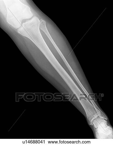 Normal lower leg. X-ray of the lower leg of a 24 year old woman. View Large Photo Image Stock Image - Normal lower leg. X-ray of the lower leg of a 24 year old woman.. Fotosearch