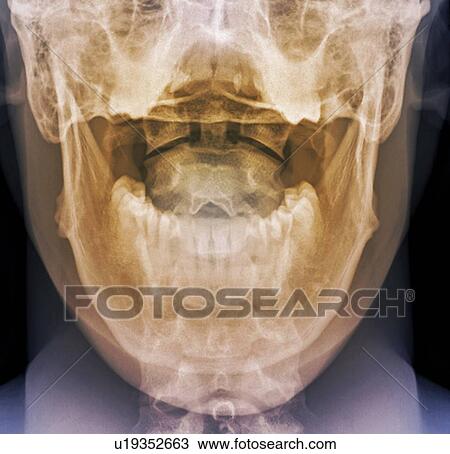 Stock Image - Normal neck. Coloured frontal X-ray of the joint between the skull and the neck.. Fotosearch